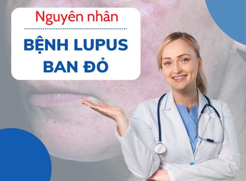 [Hỏi bác sĩ] Nguyên nhân bệnh lupus ban đỏ là gì? Cách kiểm soát bệnh hiệu quả từ sớm